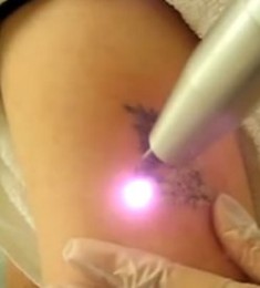 tattoo removal